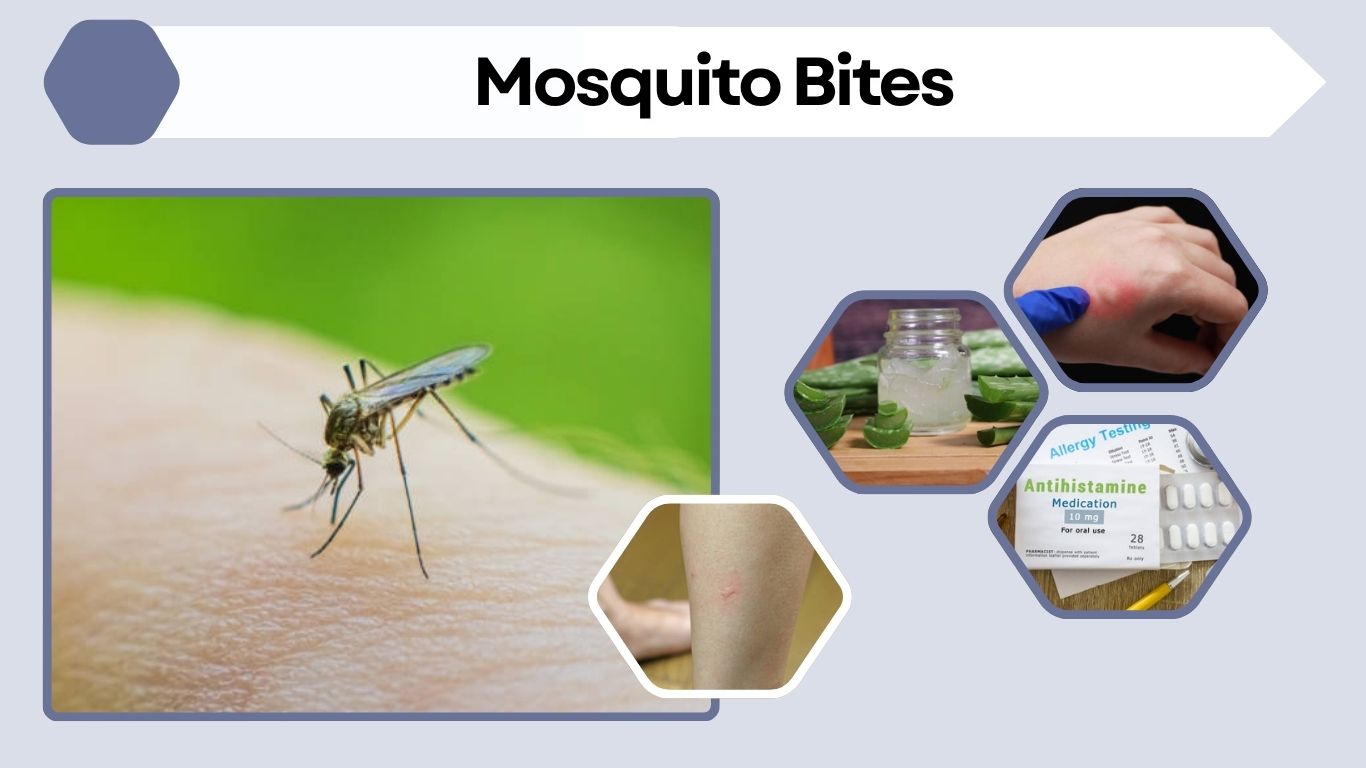 How Long Do Mosquito Bites Last? Complete Healing Guide