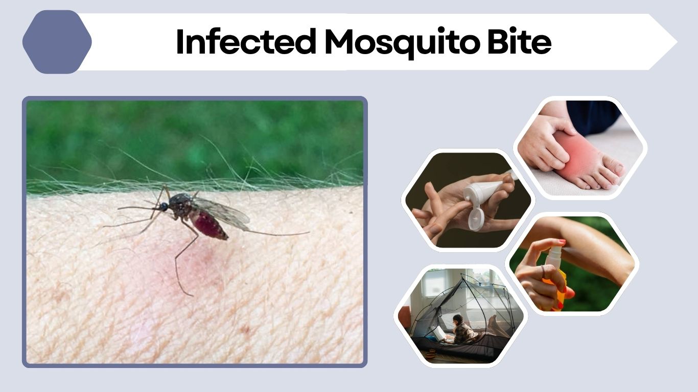Infected Mosquito Bite: Signs, Symptoms & Treatment