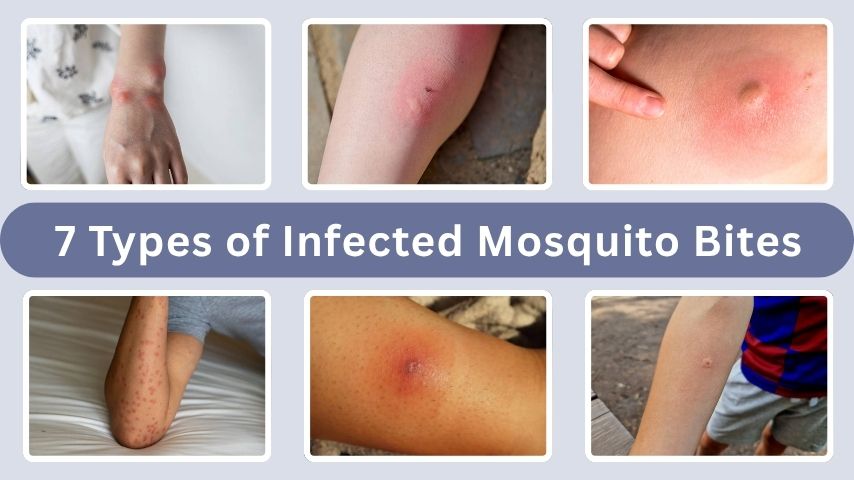 7 Types of Infected Mosquito Bites and Their Symptoms
