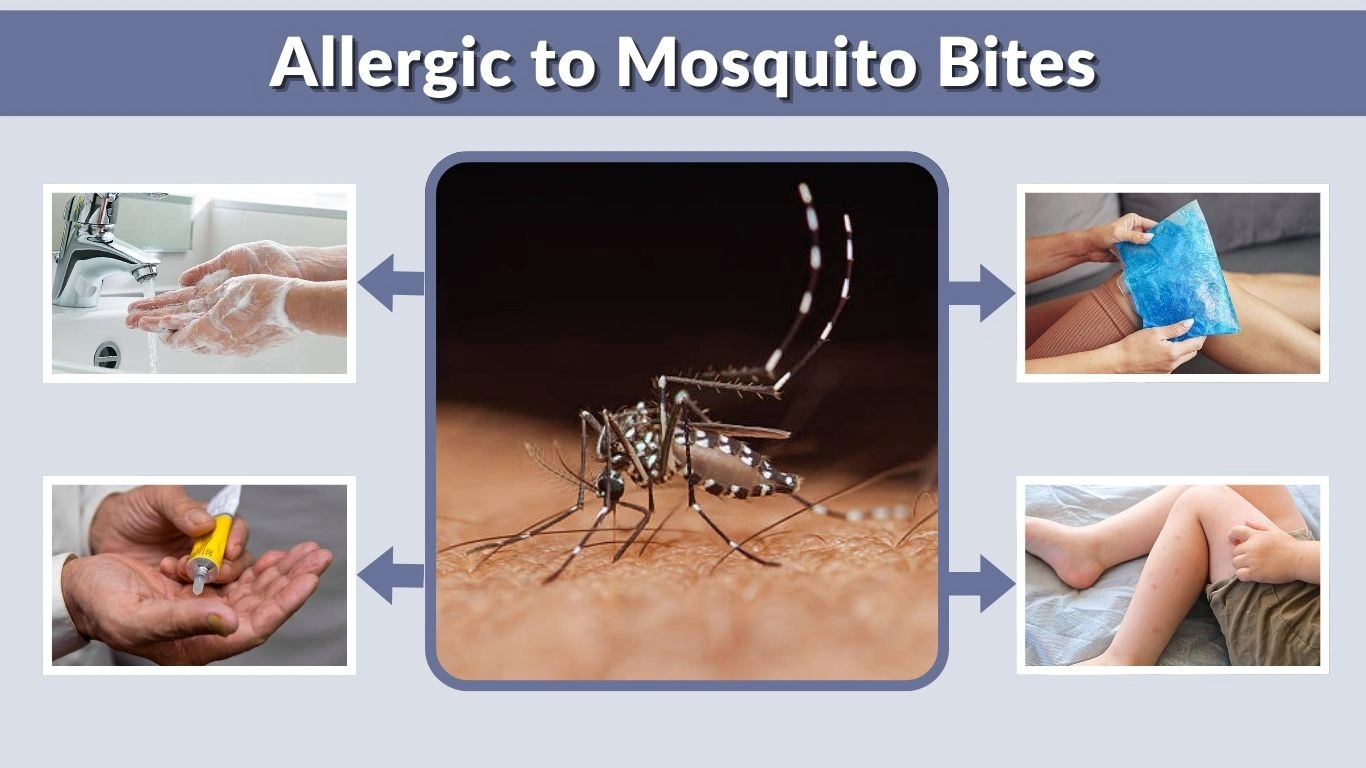 Allergic to Mosquito Bites: Symptoms and Early Treatment
