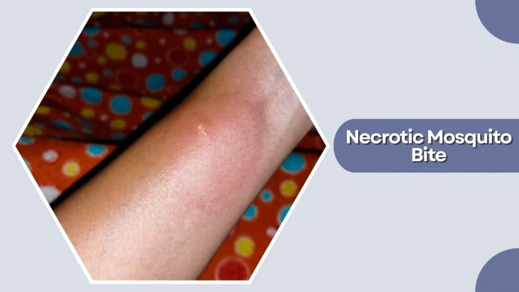 Necrotic Mosquito Bite