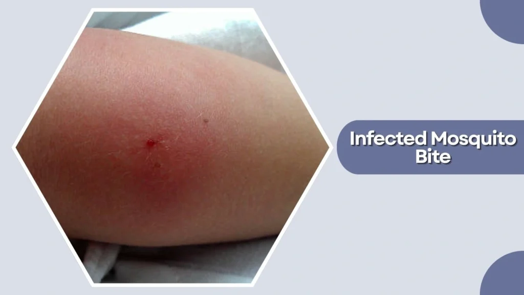 Infected Mosquito Bite