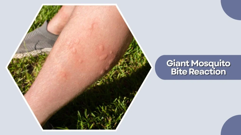 Giant Mosquito Bite Reaction