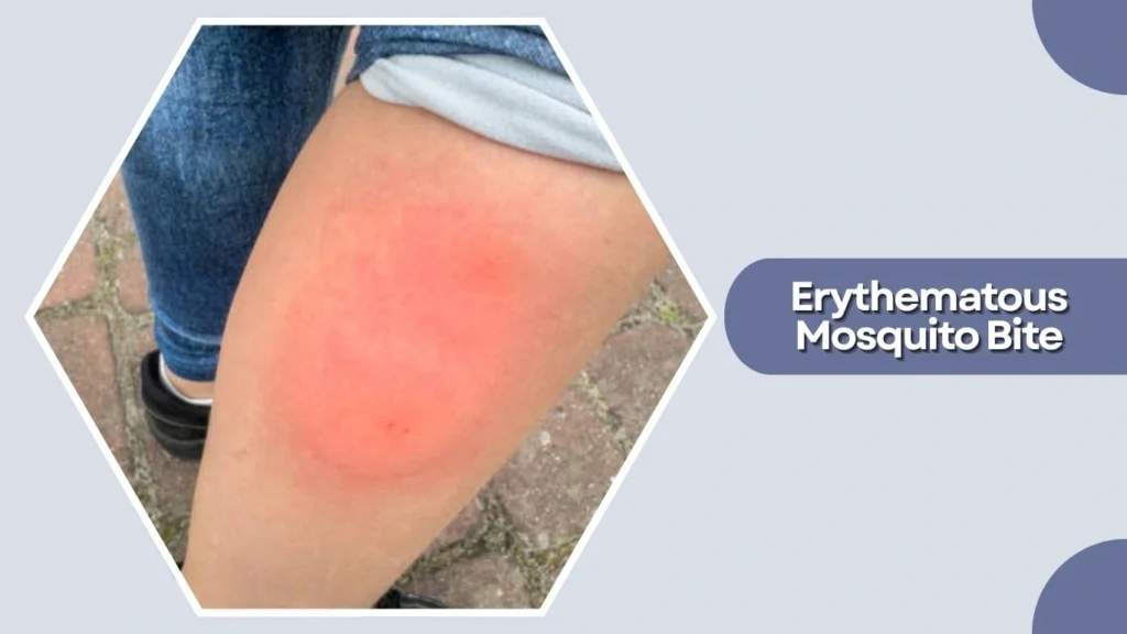 Erythematous Mosquito Bite
