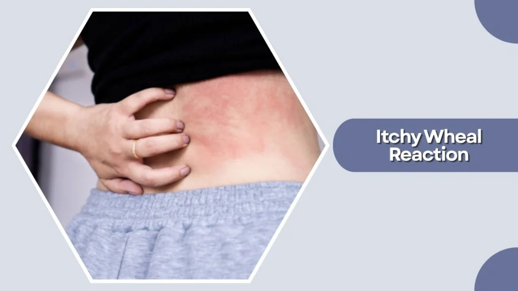Itchy Wheal Reaction