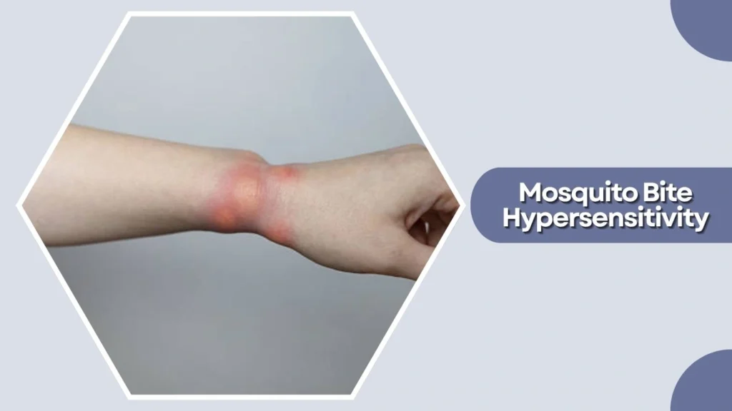 Mosquito Bite Hypersensitivity