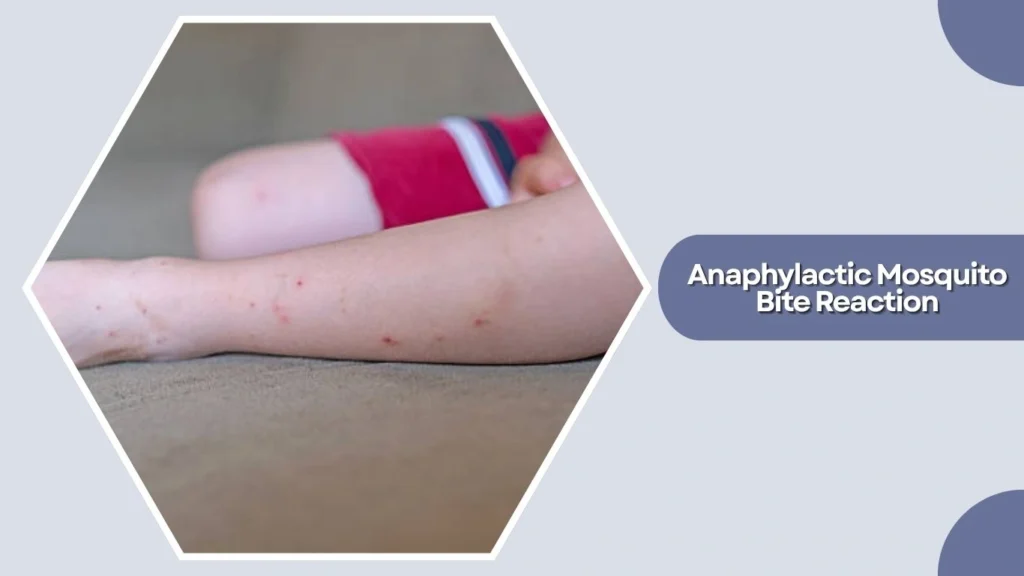 Anaphylactic Mosquito Bite Reaction
