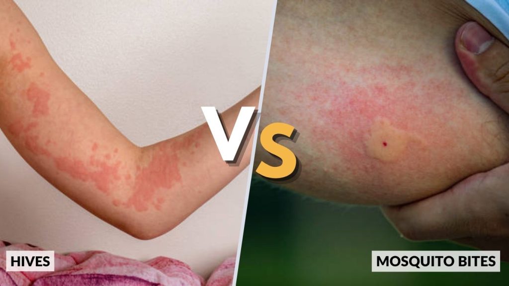 Hives vs Mosquito Bites