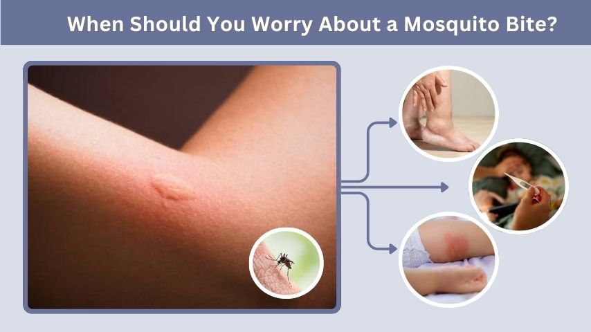 When Should You Worry About a Mosquito Bite?