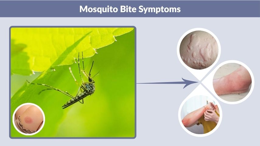 Mosquito Bite Symptoms