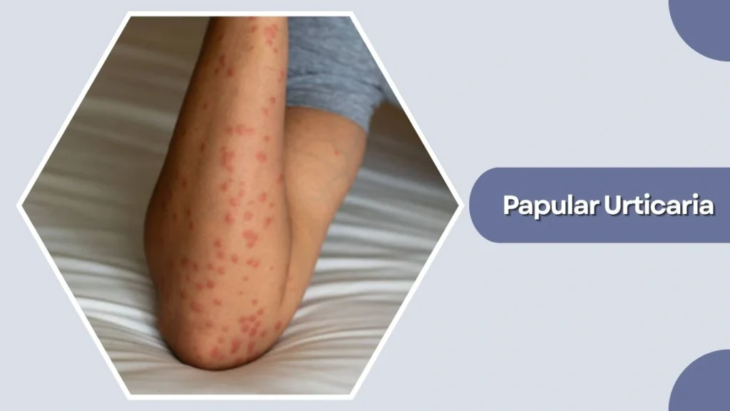 Papular Urticaria