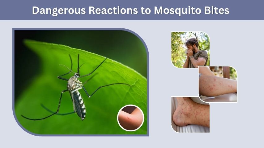 Dangerous Reactions to Mosquito Bites