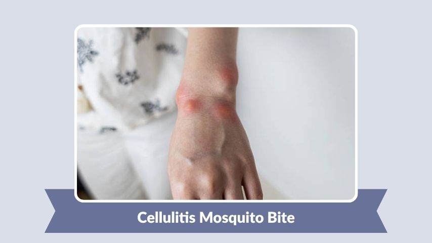 Cellulitis Mosquito Bite