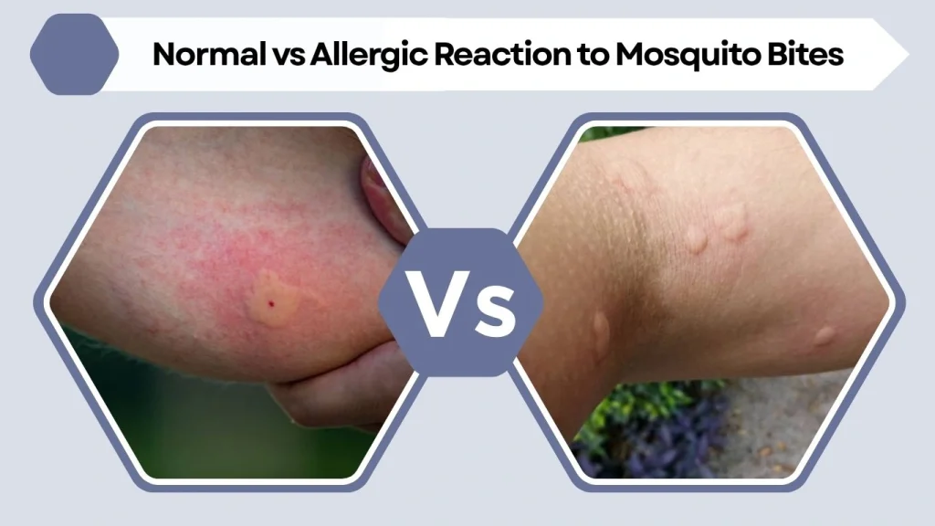 Normal vs Allergic Reaction to Mosquito Bites