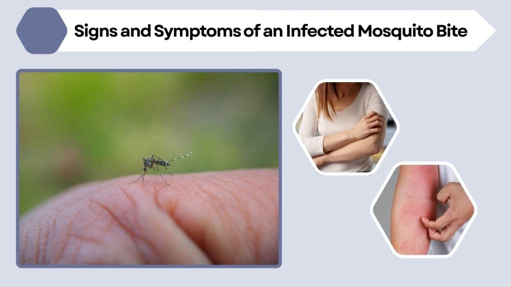 Signs and Symptoms of an Infected Mosquito Bite