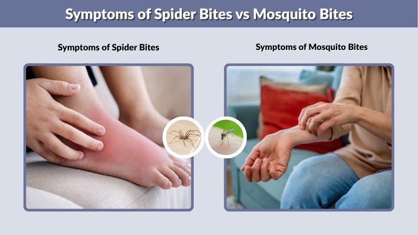 Symptoms of Spider Bites vs Mosquito Bites