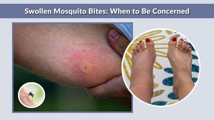 Swollen Mosquito Bites: When to Be Concerned