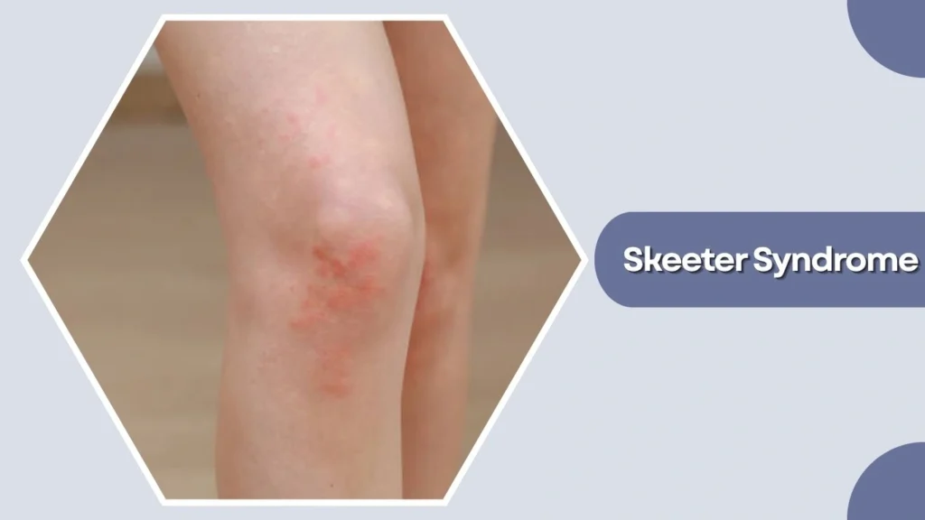 Skeeter Syndrome