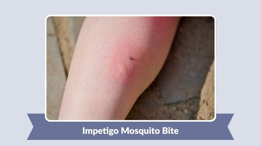 Impetigo Mosquito Bite