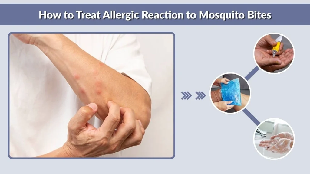How to Treat Allergic Reaction to Mosquito Bites