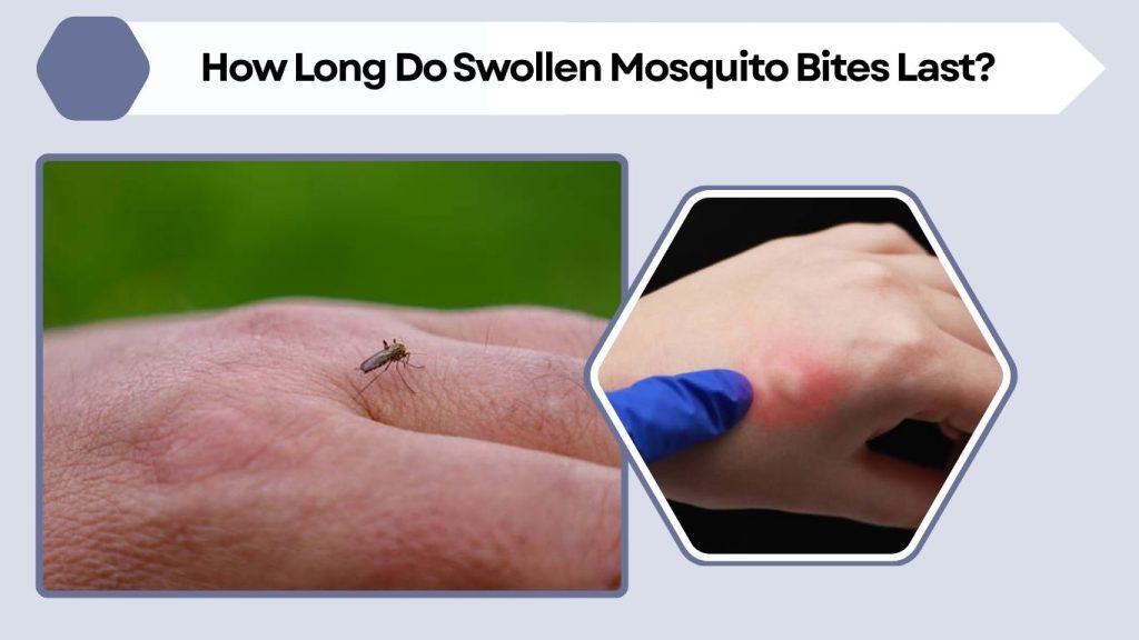 How Long Do Swollen Mosquito Bites Last?
