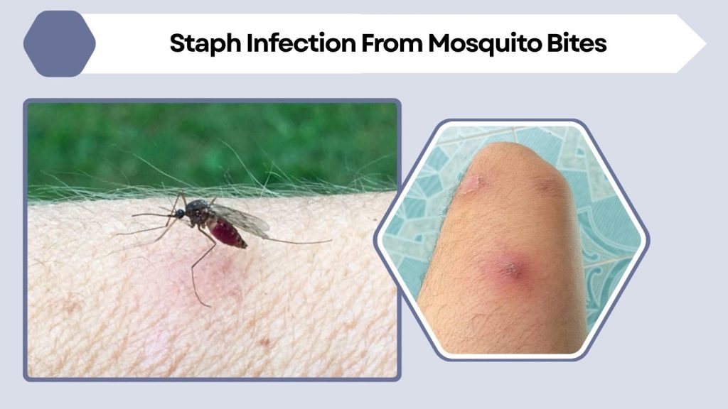 Staph Infection From Mosquito Bites