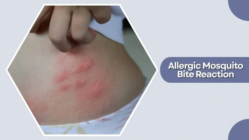 Allergic Mosquito Bite Reaction