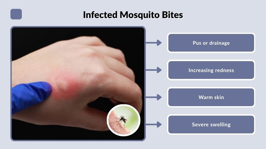 Infected Mosquito Bites
