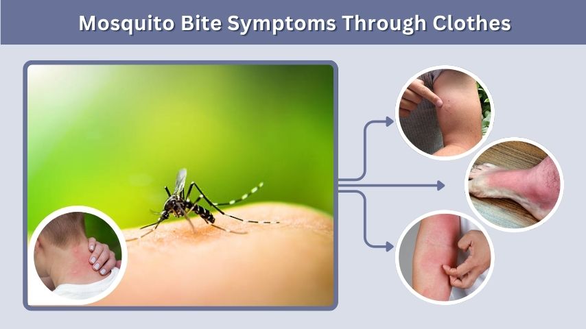Mosquito Bite Symptoms Through Clothes