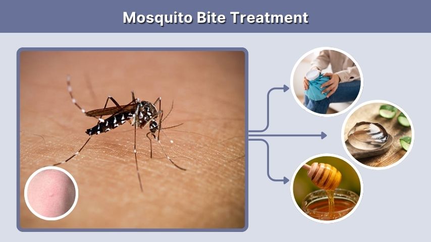 Mosquito Bite Treatment