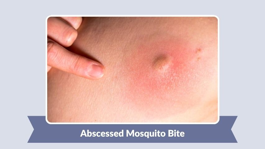 Abscessed Mosquito Bite