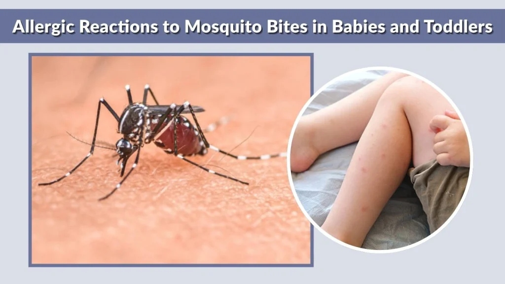 Allergic Reactions to Mosquito Bites in Babies and Toddlers