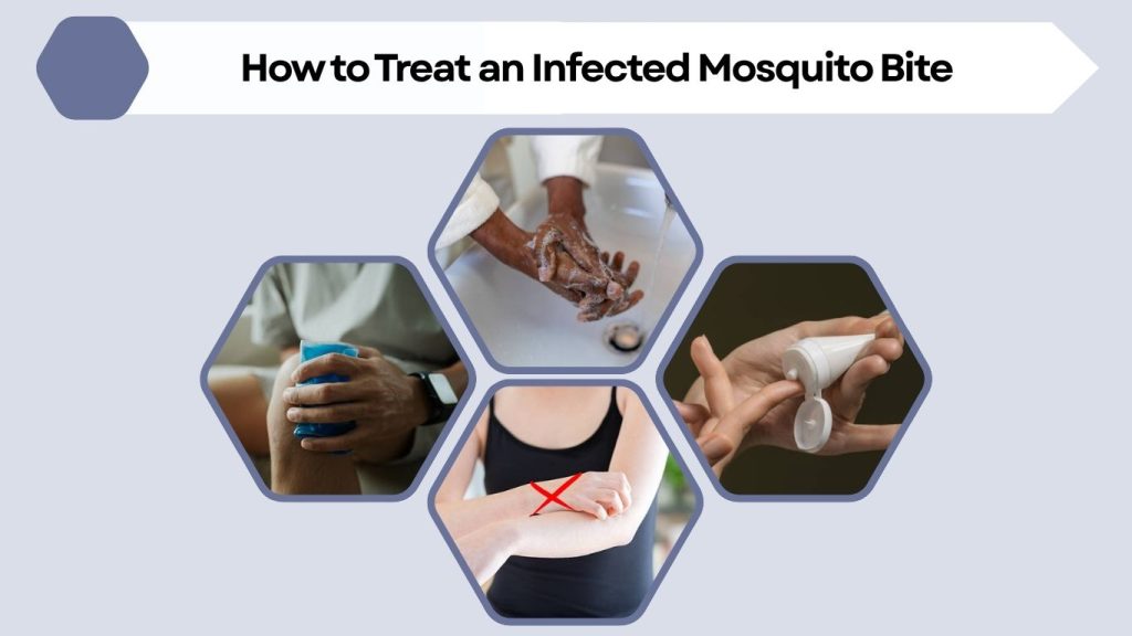 How to Treat an Infected Mosquito Bite