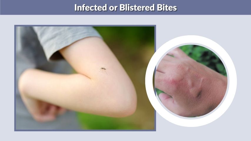 Infected or Blistered Bites
