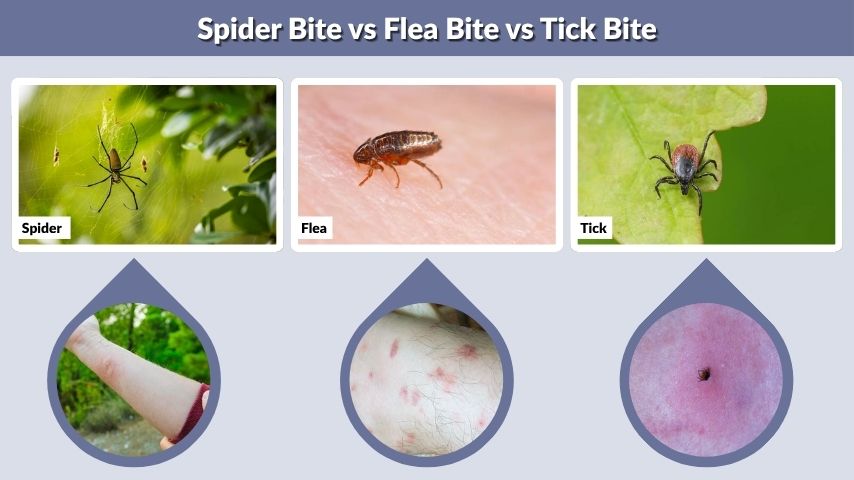 Spider Bite vs Flea Bite vs Tick Bite