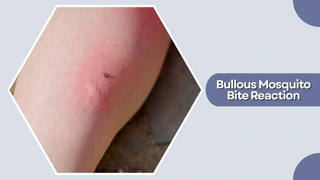 Bullous Mosquito Bite Reaction