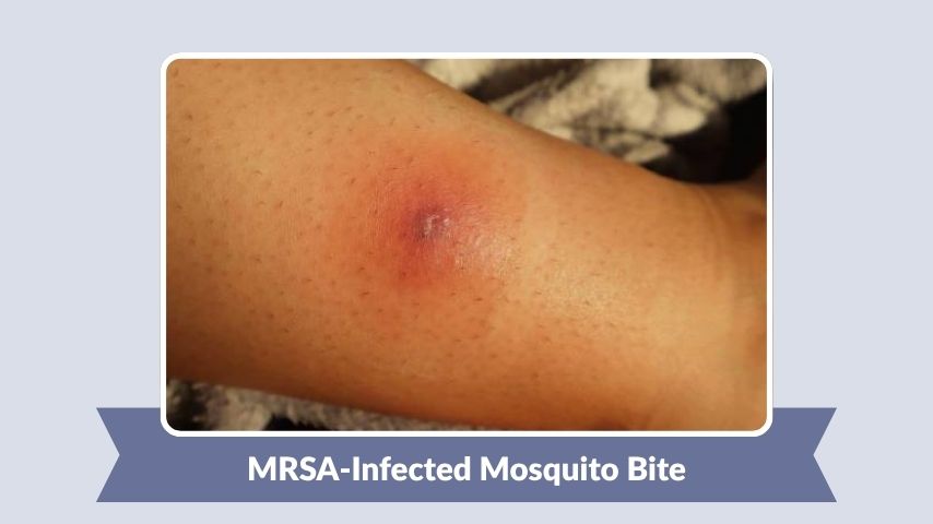 MRSA-Infected Mosquito Bite