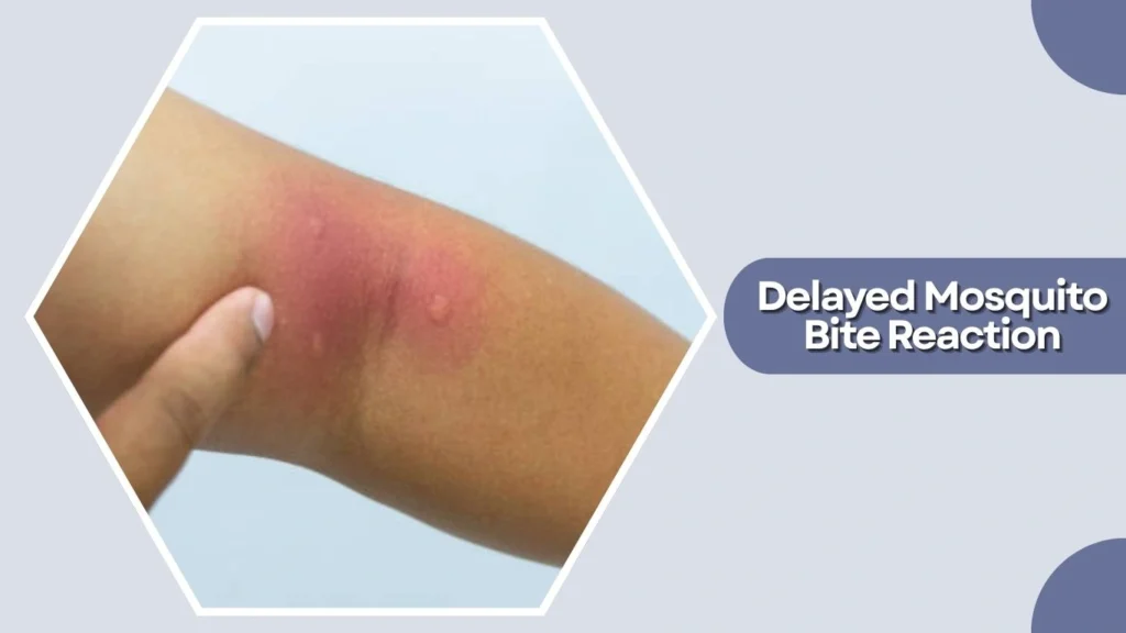 Delayed Mosquito Bite Reaction
