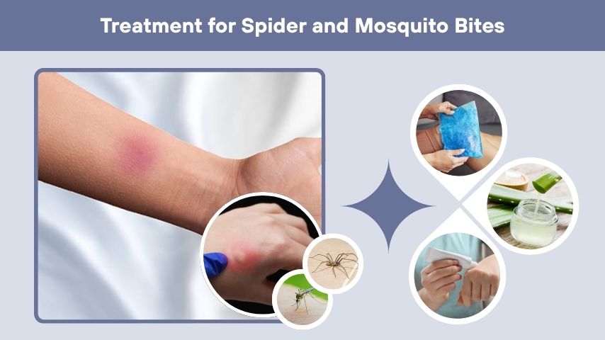 Treatment for Spider and Mosquito Bites