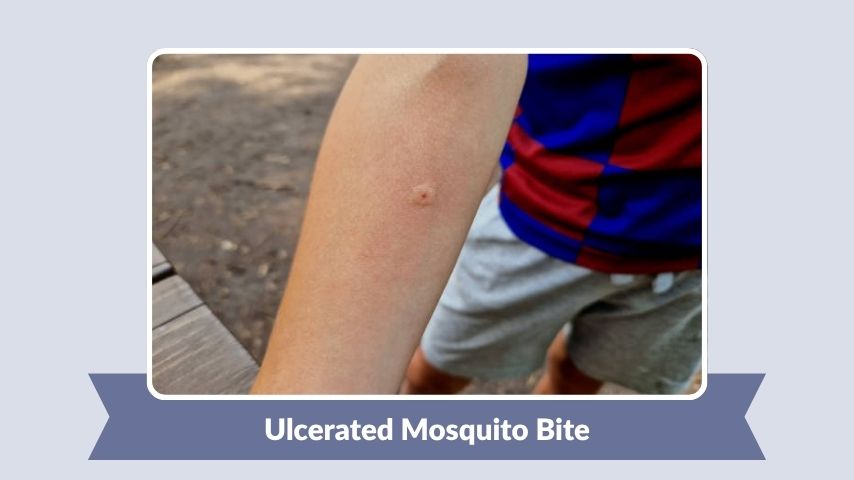 Ulcerated Mosquito Bite