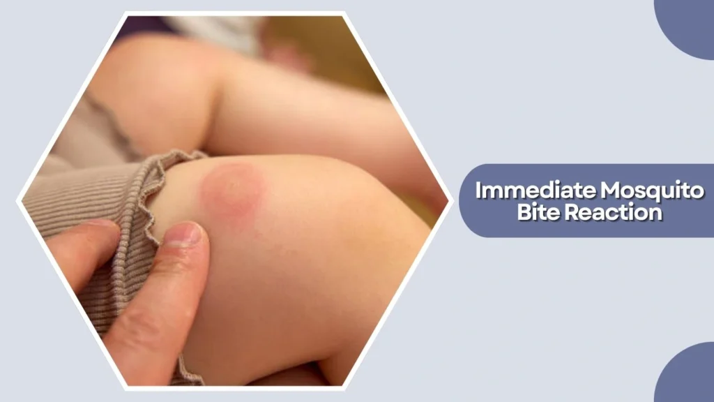 Immediate Mosquito Bite Reaction