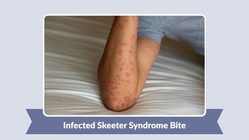 Infected Skeeter Syndrome Bite