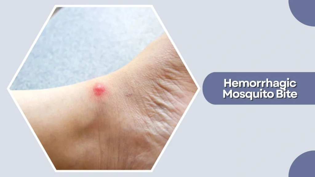Hemorrhagic Mosquito Bite