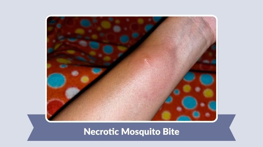 Necrotic Mosquito Bite