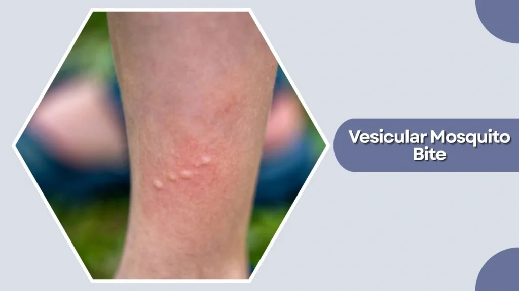 Vesicular Mosquito Bite