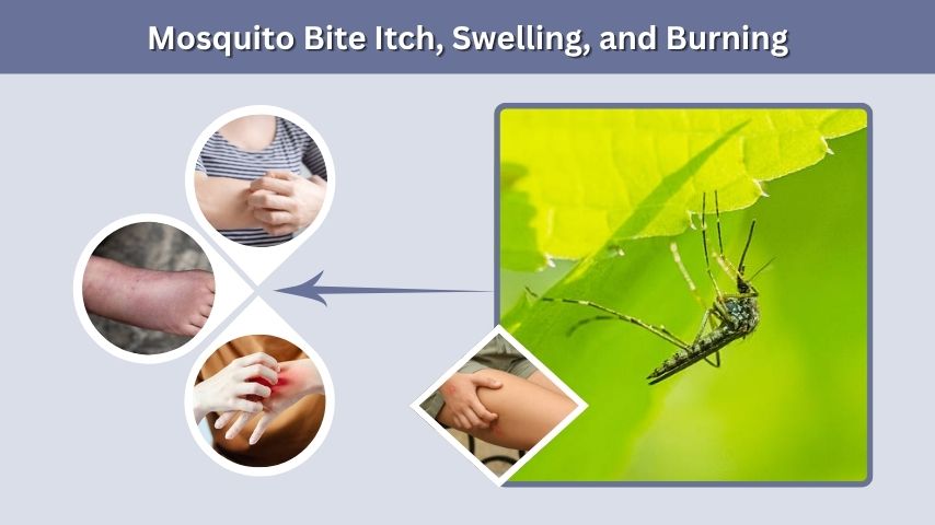 Mosquito Bite Itch, Swelling, and Burning