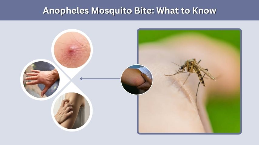 Anopheles Mosquito Bite: What to Know