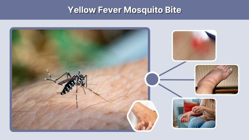 Yellow Fever Mosquito Bite
