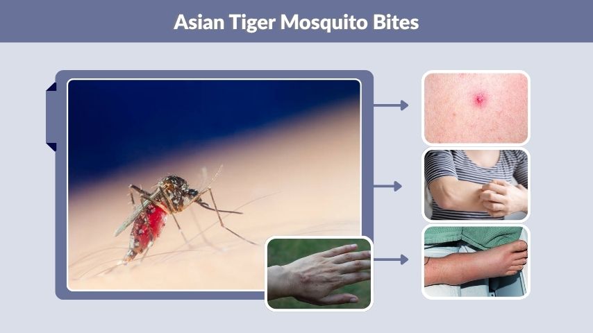 Asian Tiger Mosquito Bites