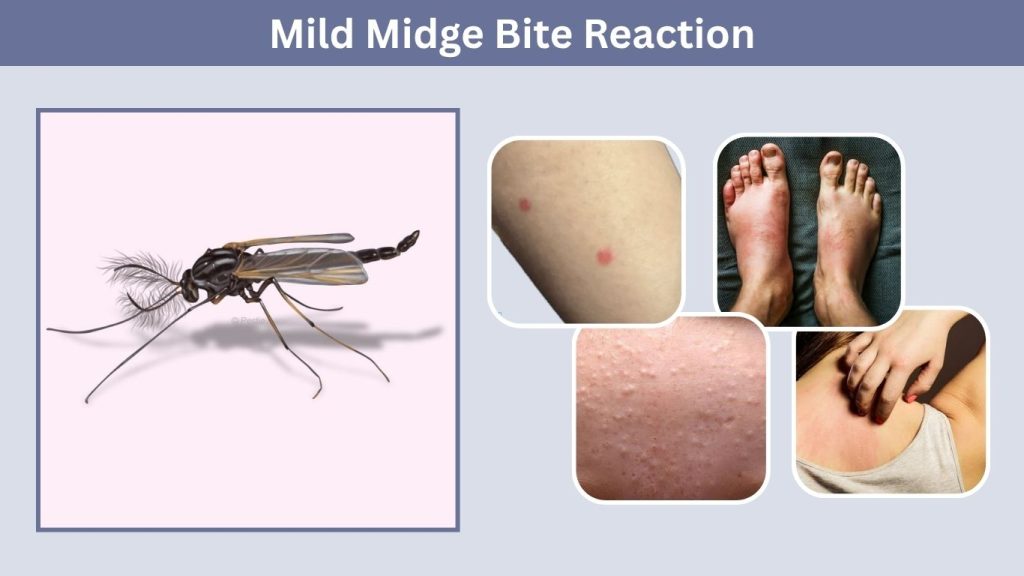 Mild Midge Bite Reaction